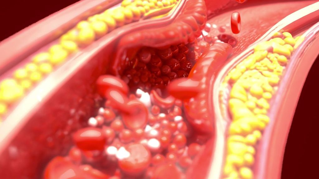 Blood Clot